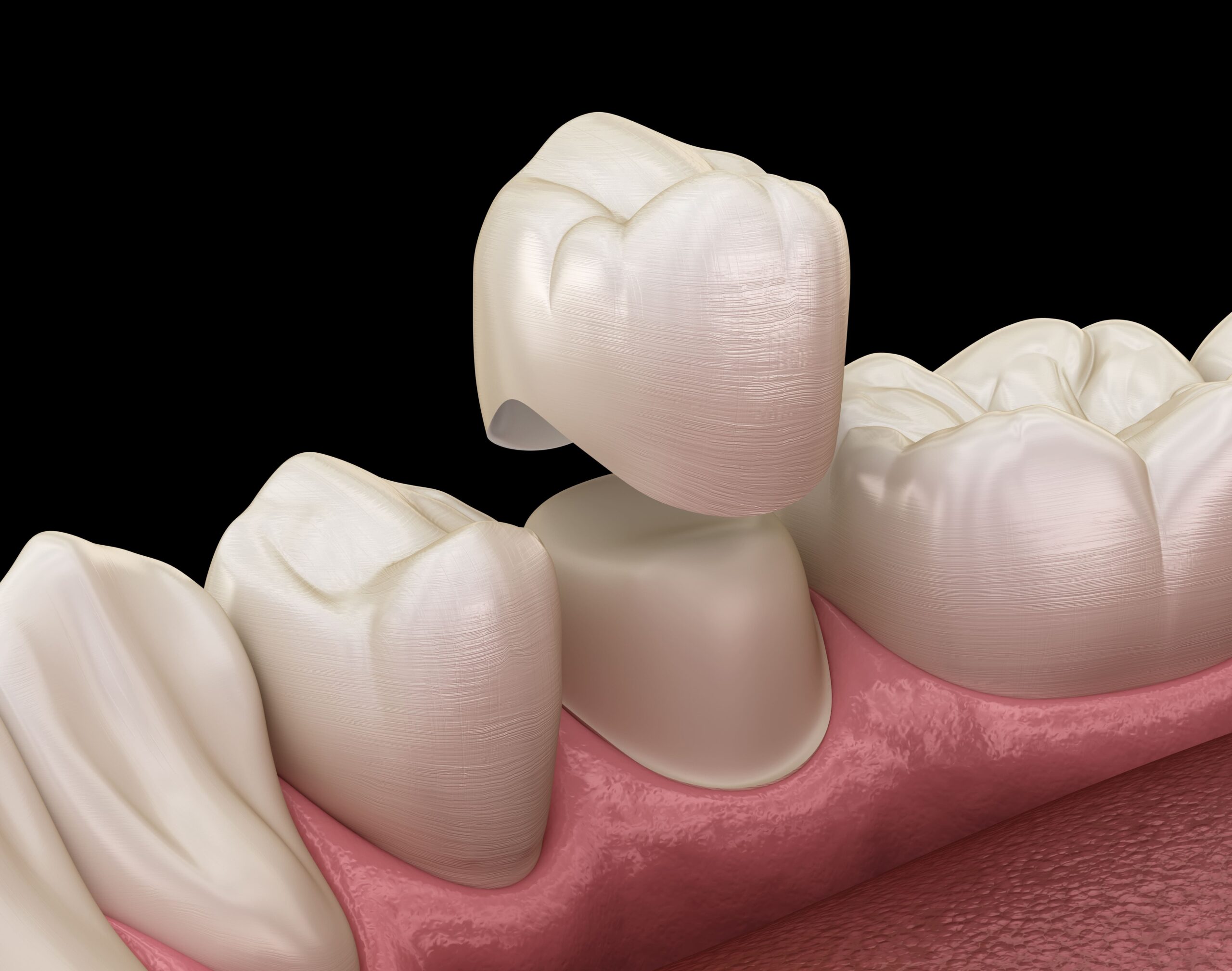 The Complete Guide to Dental Crowns