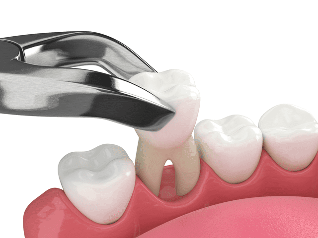 The Key Benefits of Tooth Extractions: Enhancing Oral Health and Comfort