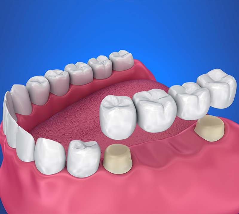 dental bridges in downtown calgary