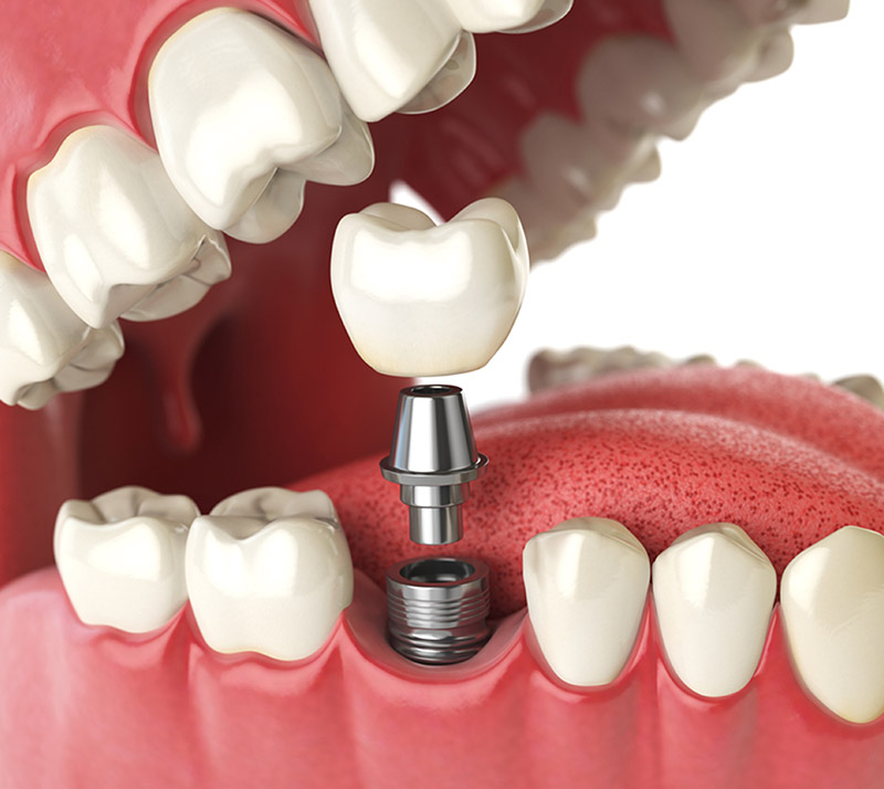 dental implants in downtown calgary