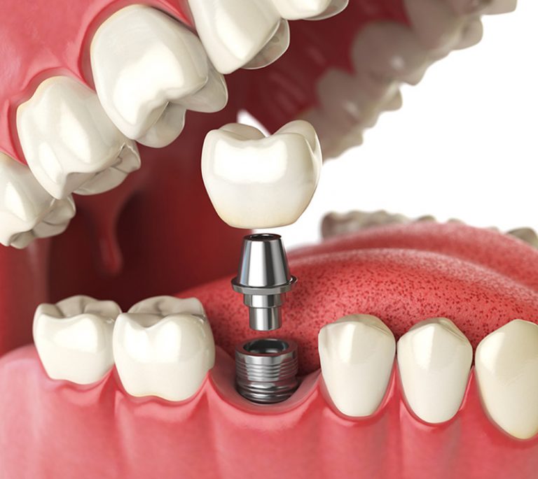 dental implants treatment demo