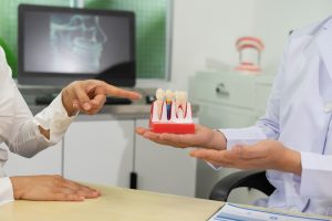 dental-implants-vs-bridges-which-lasts-longer