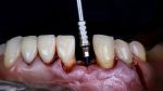 gum-swollen-around-my-dental-implant