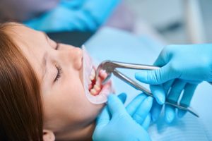 teeth extractions in lloydminster