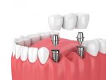 some advantages and disadvantages of dental bridges
