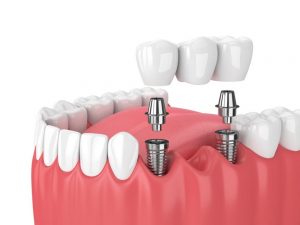 Advantages and Disadvantages of Dental Bridges
