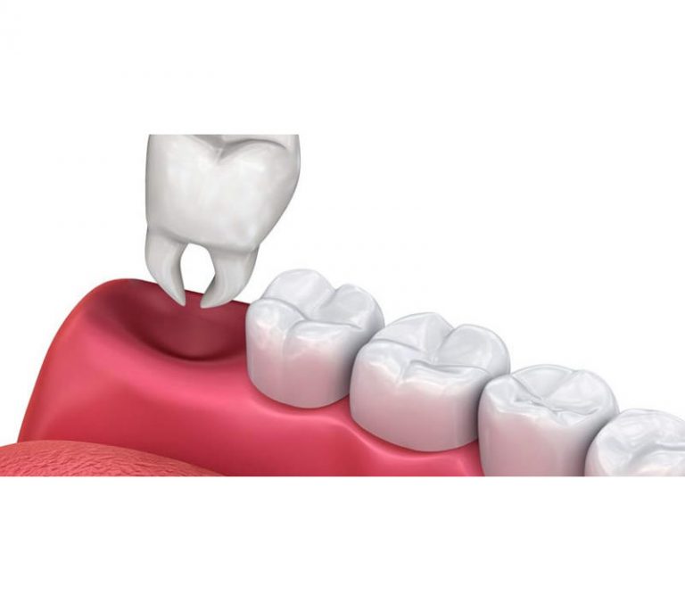 tooth extractions demo